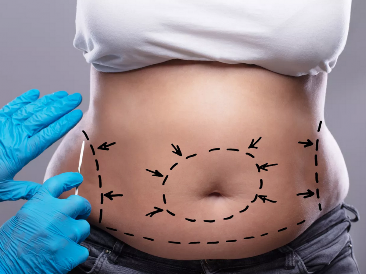 Mini-Tummy-Tuck-1200x900 https://www.surgicalmatch.com/wp-content/uploads/2023/02/Mini-Tummy-Tuck-1200x900-1.png