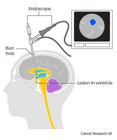 https://www.surgicalmatch.com/wp-content/uploads/2023/05/12_Diagram-showing-a-neuroendoscopy.png